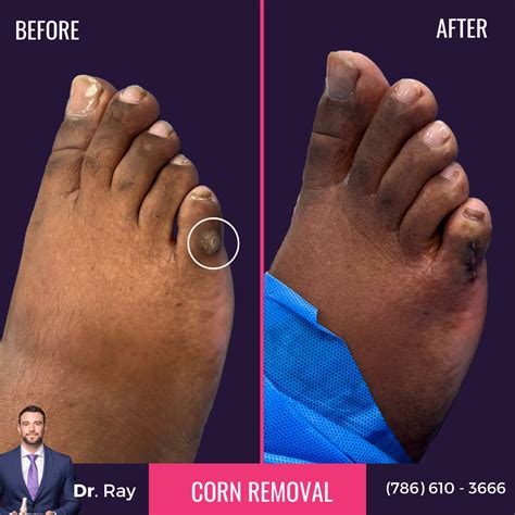 Laser Corn Removal Surgery: Starting from $1000