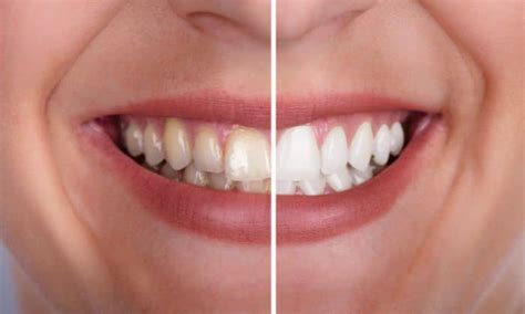 Teeth Whitening Maintenance: How to Keep Your Smile Radiant Over Time