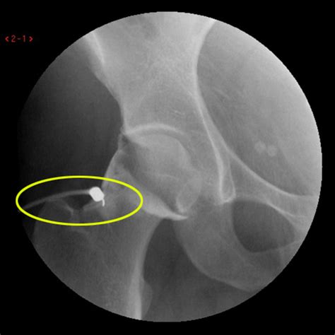 Mri Arthrogram Hip Labral Tear