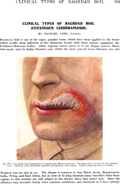 Clinical types of baghdad boil (cutaneous leishmaniasis) - Cope - 1920 - BJS (British Journal of ...