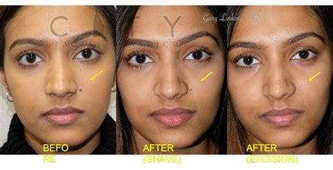 NYC Mole Removal Before and After Pictures | New York | UES