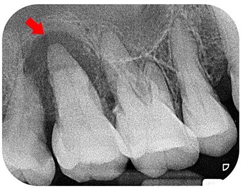 Periapical showing infected tooth - Twinkle Family Dentalcare