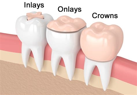 DENTAL INLAYS AND ONLAYS : INDIRECT FILLINGS | Schubbs Dental