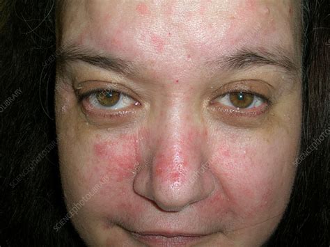 Mild Seborrheic Dermatitis Face