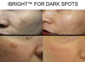 Laser treatment of Dark Spots and Melasma in San Antonio Boerne