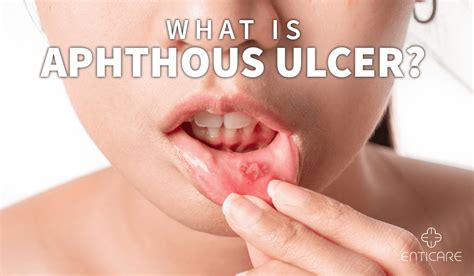 What is Aphthous Ulcer? | Enticare Ear, Nose, and Throat Doctors