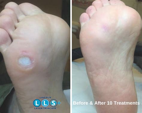 Warts & Verrucas Removal – Lincoln Laser Skin Care