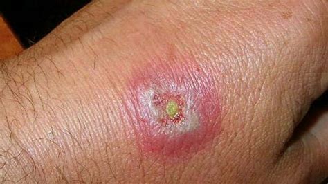 Hobo Spider Bite - Is It Life-Threatening? Find Out 9 Best Prevention ...