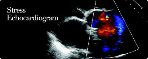 Stress Echocardiogram | Ruth Kam Heart & Arrhythmia Clinic