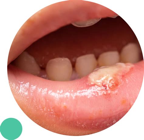 Online Doctor For Oral Thrush Medical Treatment For Oral Thrush Causes Of Oral Thrush TelMDCare