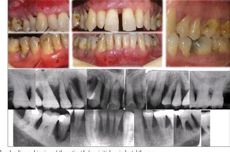 Figure 1 from Periodontal treatment in a generalized severe chronic periodontitis patient: A ...