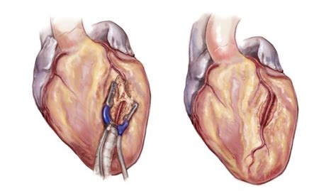 Myocardial Bridge Unroofing | Department of Cardiothoracic Surgery ...