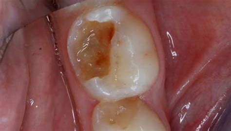 Occlusal view of the carious lesion tooth 75. Infected carious dentin... | Download Scientific ...