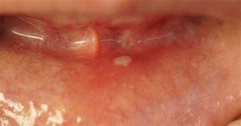 Cracking the Canker Code: Diving into the White Depths of Oral Sores