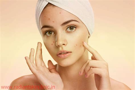 Best Acne Scar Treatment in Jaipur- Dr Vishal Chugh