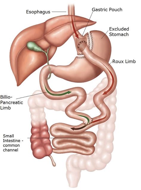 Roux En Y Gastric Bypass vs Sleeve Gastrectomy - Which One is Best for You?