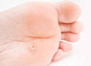 11 Most Common Foot Lumps and Bumps Explained