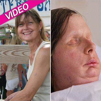 Charla Nash Reveals Face Transplant After Brutal Chimp Attack