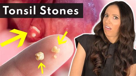 Tonsil Stones