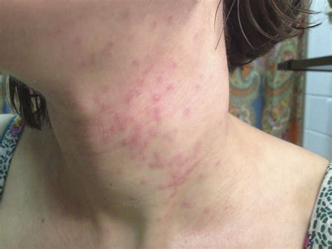 Itchy Rash On Shoulders