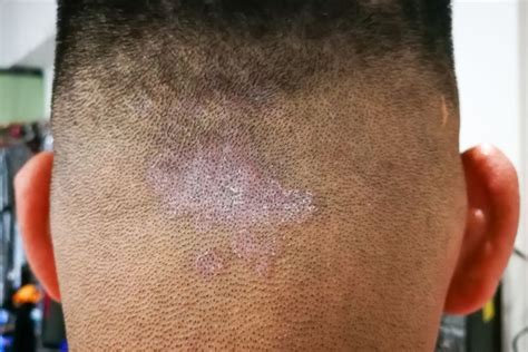 Scalp Ringworm - Tinea Capitis Symptoms, Treatment and Cure – Traya