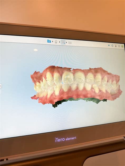 My Crossbite Invisalign Before and After Results in 10 months