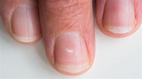 Do you have white marks on your fingernails? This is what they mean… and when you should go to ...