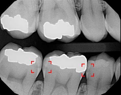 Help Your Mouth: How Much Radiation Is in a Dental X-Ray?