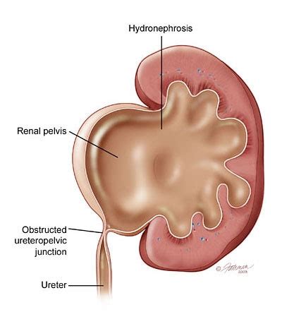 Ureteropelvic Junction (UPJ) Obstruction: Symptoms, Diagnosis & Treatment - Urology Care Foundation