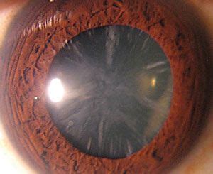 cortical cataract - Hledat Googlem | Ojos