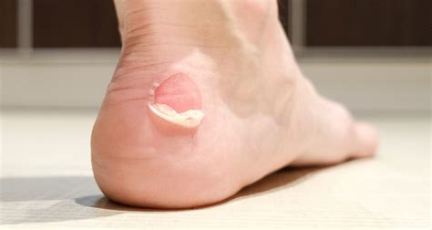 Blisters - Our simple guide to treating and preventing them