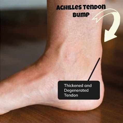 Achilles Tendonitis | Treatment for Heel Pain and Symptoms | Alleviate Pain Clinic