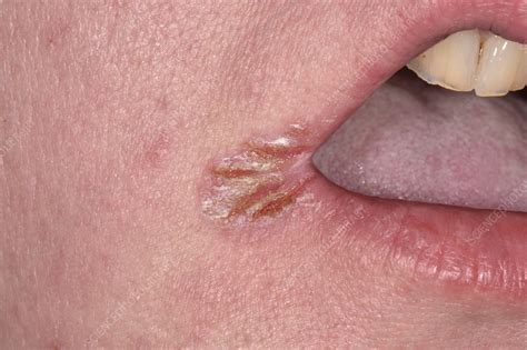 Angular cheilitis - Stock Image - C047/2876 - Science Photo Library