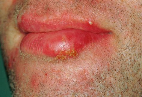 Cold Sore (herpes Simplex Lesion) On Patient's Lip Photograph by Dr P. Marazzi/science Photo Library