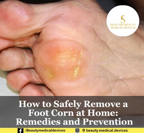 How to Safely Remove a Foot Corn at Home: Remedies and Prevention