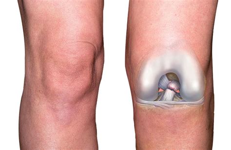 Acute ACL Injury & Its Causes, Sign-Symptom & Treatment | ASPC ...