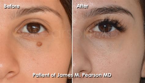 34+ Billings Plastic Surgery Before And After PNG - Richard L. Mullins