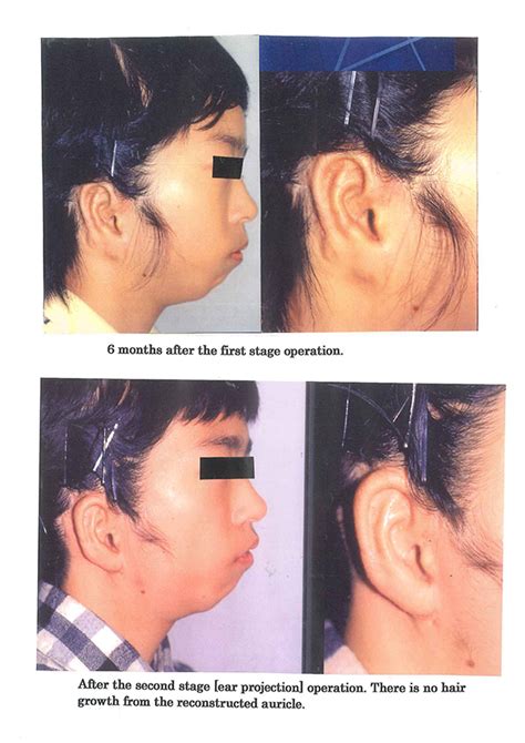 Anotia｜Nagata Microtia and Reconstructive Plastic Surgery Clinic