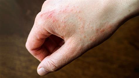 Hives On Hands
