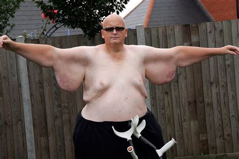 Former world's fattest man refused op to remove excess skin after 40st ...