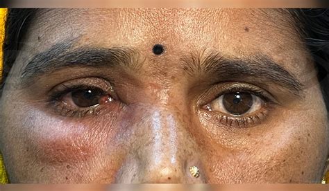 DCR Eye Treatment | Best Endoscopic DCR Surgeons in Ahmedabad