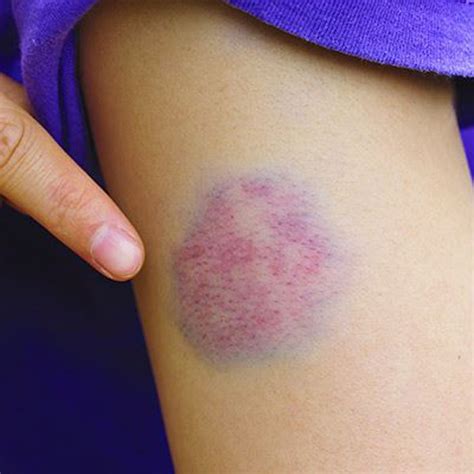 reasons for constant bruises on your body, नील के निशान, Bruise marks....