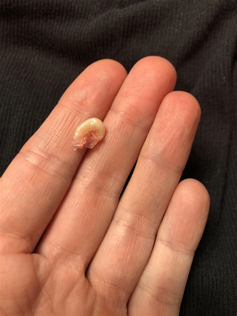 Sebaceous cyst. Just pulled this out of my head with tweezers. Made a nice little pop. : r/popping