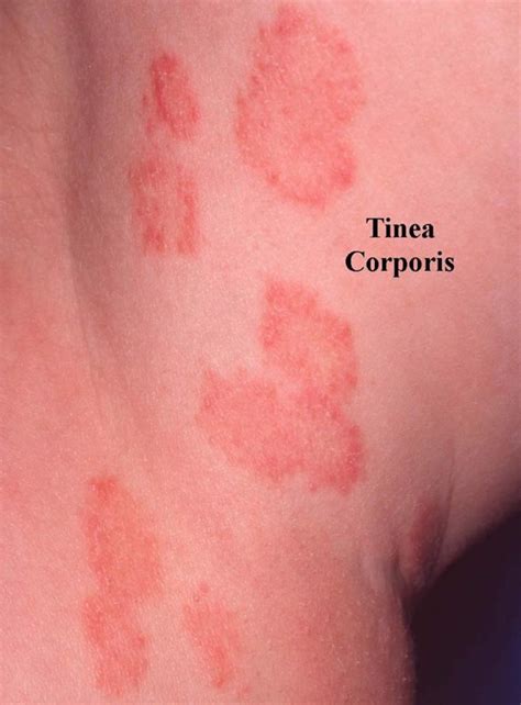 Ringworm Tinea Causes Signs Symptoms Diagnosis Treatment – NBKomputer