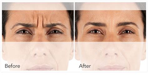 Information on Xeomin, A New Botox - Cohen Laser & Vision Center