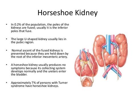 Horseshoe Kidney - Αναζήτηση Google (With images)