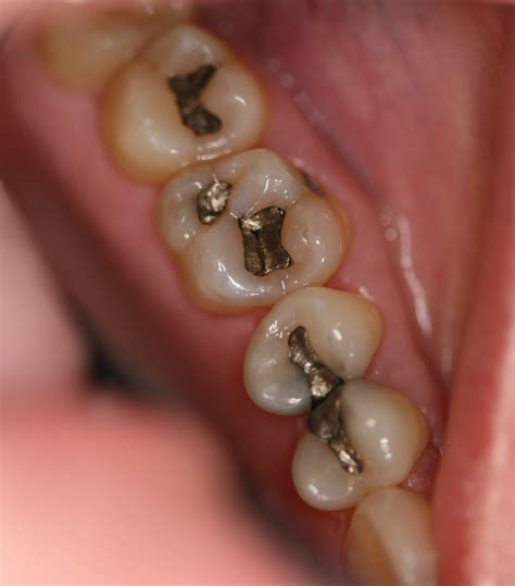 Composite Resin Fillings | Nadim J Jubran DDS PC