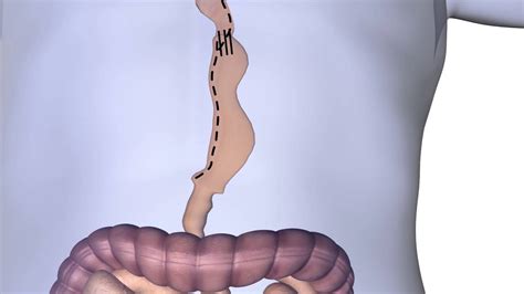 Esophagectomy Procedure Animation - YouTube