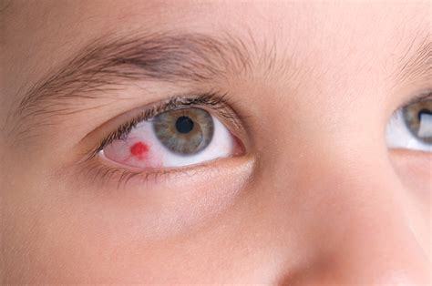 Burst Blood Vessel | Optometrist in Houston | Eye Site