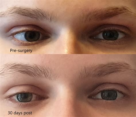 My strabismus surgery experience - UK : r/Strabismus